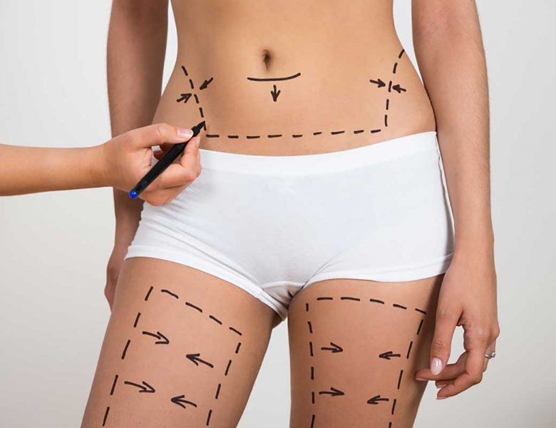 Lazer Liposuction Nedir? Nasıl Uygulanır?